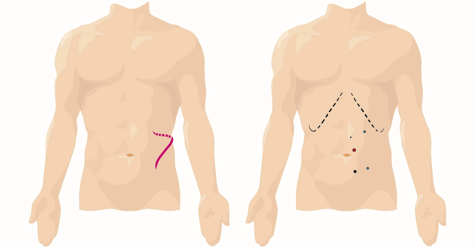 &Rho;&omicron;&mu;&pi;&omicron;&tau;&iota;&kappa;ή &Mu;&epsilon;&rho;&iota;&kappa;ή &Nu;&epsilon;&phi;&rho;&epsilon;&kappa;&tau;&omicron;&mu;ή