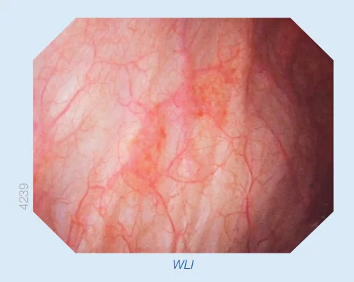 &Kappa;&upsilon;&sigma;&tau;&epsilon;&omicron;&sigma;&kappa;ό&pi;&eta;&sigma;&eta; &mu;&epsilon; &Lambda;&epsilon;&upsilon;&kappa;ό &Phi;&omega;&sigmaf;