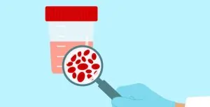 αιματουρία 